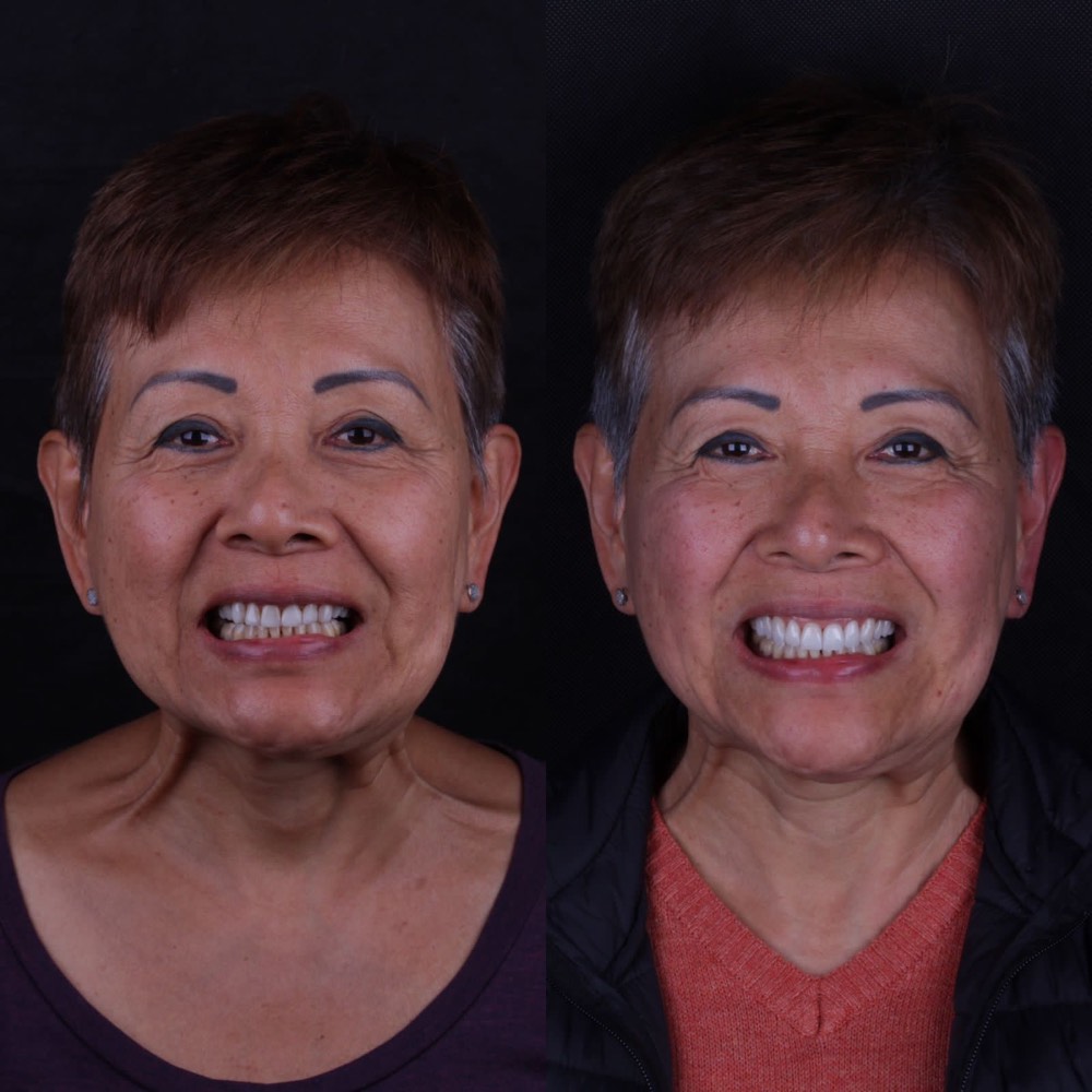 Antes e depois de paciente reabilitada com próteses