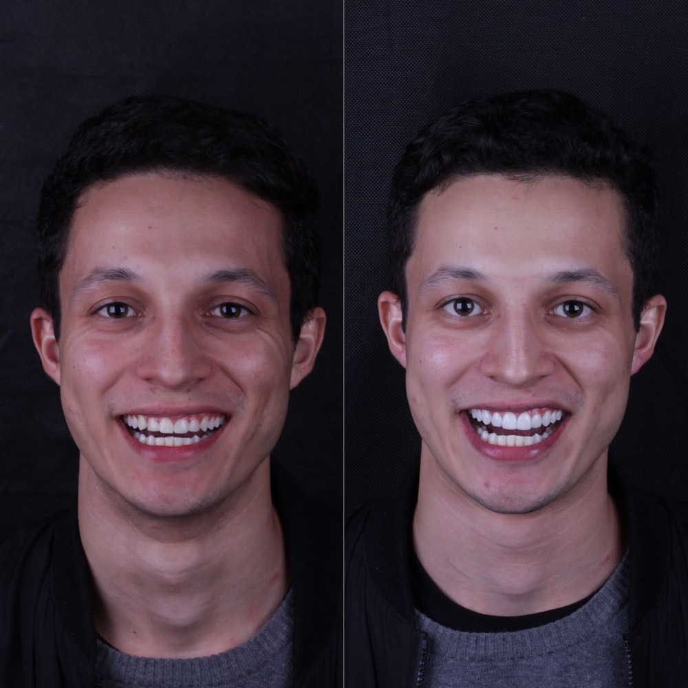 Antes e depois de paciente após tratamento reabilitador
