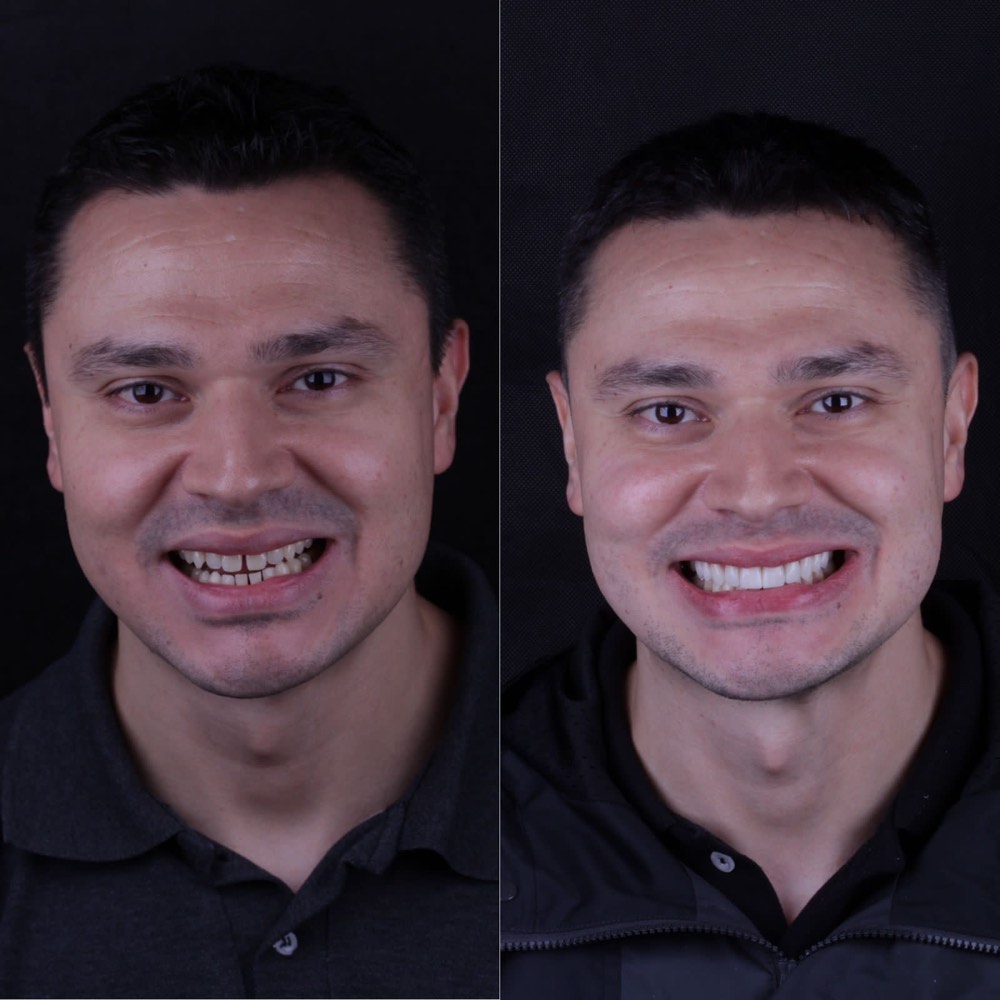 Antes e depois de paciente após tratamento
