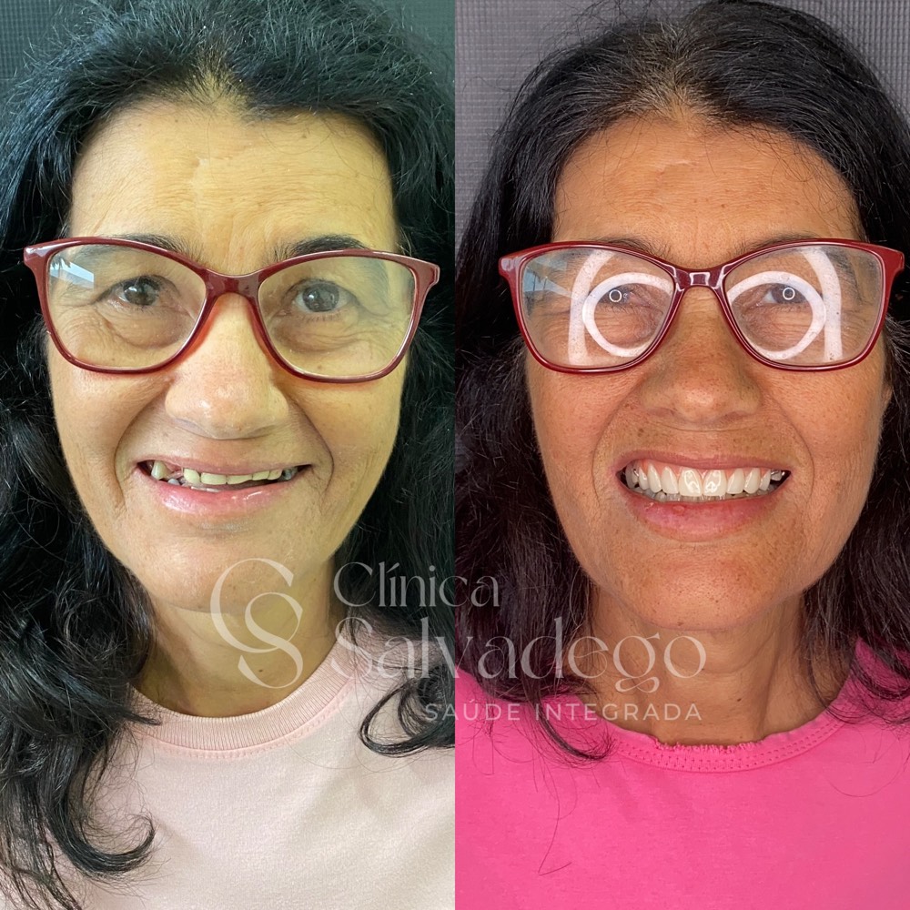 Antes e depois de paciente após reabilitação com prótese