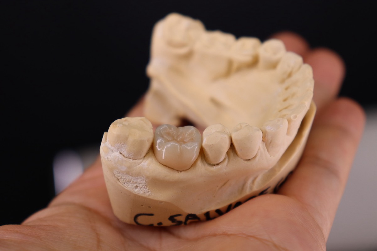 Coroa sobre implante dentário em modelo de gesso, Clínica Salvadego