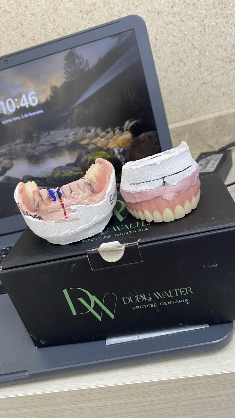 Próteses dentárias sobre modelos de gesso durante o planejamento