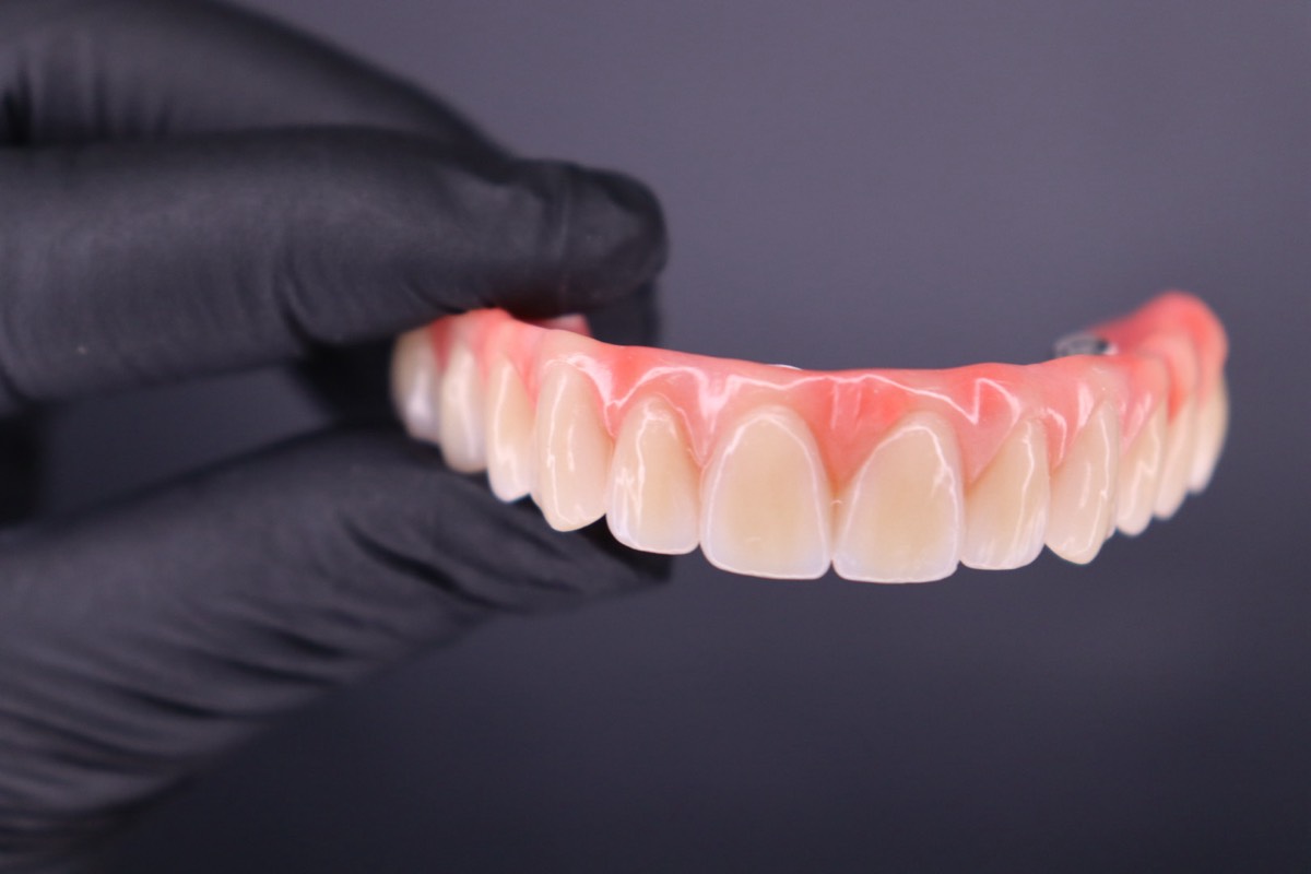Detalhe da prótese protocolo sobre implantes